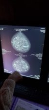 Маммограф Sectra MicroDose L30