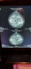 Маммограф Sectra MicroDose L30