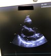 УЗИ GE Healthcare Vivid T8