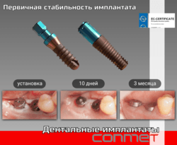 Первичная стабильность имплантата КОНМЕТ!