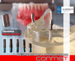 Имплантаты КОНМЕТ - возможности для пользователей системы!