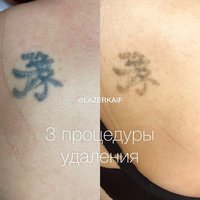 Неодимовый лазер MBT 800WY