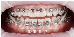Брекеты Damon Q2