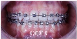 Брекеты Damon Q