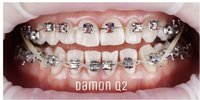 Брекеты Damon Q2