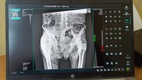 Комплект для выездной цифровой рентгенографии