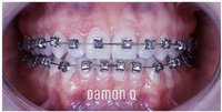 Брекеты Damon Q