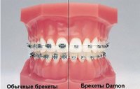 Брекеты Damon Q