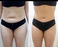 Продам аппарат для похудения Liposphere\сферотерапия
