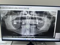 GENDEX GXDP-300 - цифровая панорамная рентгенодиагностическая система KaVo (Германия)