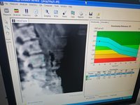 Костный рентгеновский денситометр Prodigy Advance GE