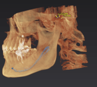 Томограф OP 3D 9*14 с цефалостатом (pan,ceph,3D)