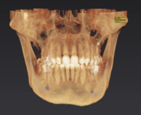 Томограф OP 3D 9*14 с цефалостатом (pan,ceph,3D)