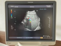 Узи сканер Toshiba Aplio MX