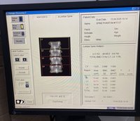 Денситометр Hologic Discovery