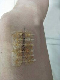 Пластырь для скрепления краев раны без наложения швов SKIN-FIX